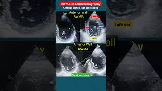 RWMA of Anterior Wall Echo l Part2 l हार्ट अटैक इको echo shorts [upl. by Inna]