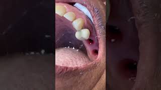 Doctor Tips an instructional video closedtray impression tissue guide Neodent GM implants [upl. by Dnomrej]