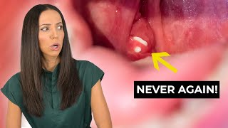 How to PREVENT Tonsil Stones [upl. by Eetsud]