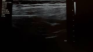 suprascapular nerve block 24110101 [upl. by Farrel]