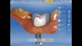 Coroane dentare si bont protetic realizate digital intro singura sedinta cu Cerec CadCam [upl. by Gillman]