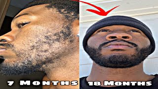 VELLUS TO TERMINAL HAIRS SLIDESHOW MUST WATCH  MINOXIDIL BEARD TRANSFORMATION [upl. by Pulcheria181]