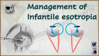 Infantile esotropia simplified 2│Management [upl. by Eadrahs]