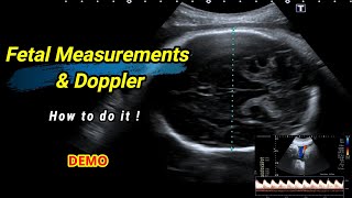 Fetal measurements and Doppler  How to do it [upl. by Robison]