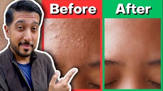 How to Rid Fungal Acne  Fungal Acne Treatment THAT WORKS for Malassezia Folliculitis [upl. by Floyd]