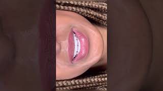 Porcelain Veneers in Dubai  Dr Nazima Yakubova dentist veneers cosmeticdentistry [upl. by Publias]