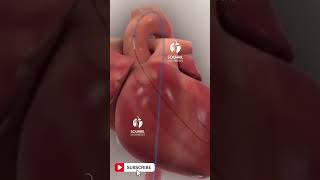 Animation of balloon angioplasty with stent procedure [upl. by Anaytat]