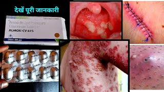 गोली 1 काम अनेक  Almox Cv 625 tablet uses in hindi  Amoxicillin amp potassium clavulanate in hindi [upl. by Zsazsa]