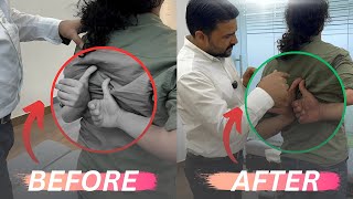 Shoulder blade pain treatment by dr harish grover [upl. by Eilime978]