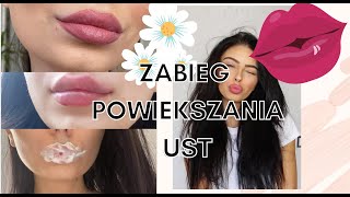 POWIĘKSZYLAM USTA  wszystko o moim zabiegu czy boli dlaczego się zdecydowałam porady [upl. by Elacsap]