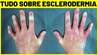 ESCLERODERMIA  O QUE É SINTOMAS E TRATAMENTO [upl. by Jennette174]