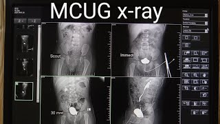 MCUGVCUG xRay procedure micturating cystourethrogram  MCUGVCUG test in Radiology [upl. by Atinrahc]