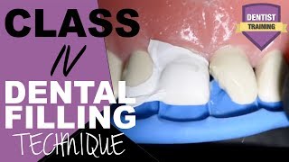 Class IV Composite Filling Tutorial  Front Tooth Filling [upl. by Daley712]