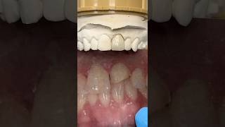 Replacing a chipped tooth lsk121shorts dentistteeth [upl. by Ruenhcs]