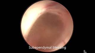 Subependymal Bleeding in Neuroendoscopy [upl. by Aramac]