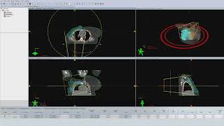 VMAT Technique for RightSide BreastCW Cancer with Flash Planning Radiotherapy [upl. by Elia]