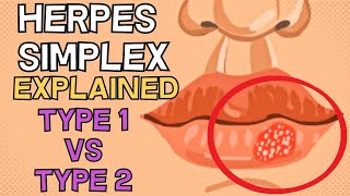 Herpes Simplex  Type 1 vs Type 2  EXPLAINED IN 2 MINUTES [upl. by Hniv]