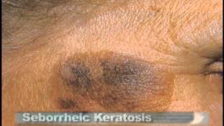 Common Skin Lesions [upl. by Ervine]