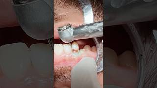 Tooth caries  composite restoration dentist [upl. by Nigam27]