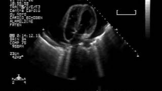 echocardiogram massive2pericardial effusion with cardiac tamponade4chambers view [upl. by Ner650]