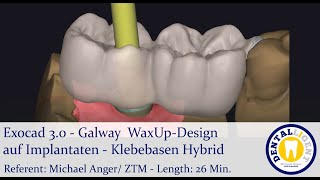 2021 Exocad Tutorial 30  Galway WaxUpDesign auf Implantaten  Klebebasen Hybrid [upl. by Hillell509]