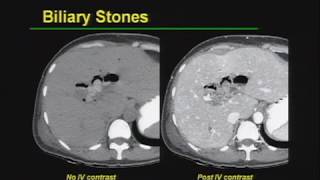 Biliary Tract Imaging Basic Radiology [upl. by Valdis]