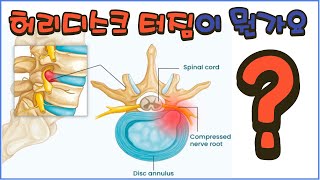 허리디스크 터짐이 뭔가요 [upl. by Attenaj]