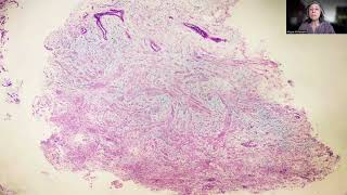 Tip63 Myometrial Myxoidosis [upl. by Floridia]