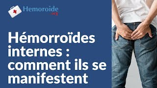 Hemoroide interne  tout comprendre sur les hemorroides internes [upl. by Origra]