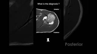 MRI arthrogram – shoulder Quiz 22 radiologychannel007 [upl. by Henebry]