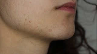 UPDATE 1 FACIAL HAIR ELECTROLYSIS VS LASER HAIR REMOVAL  PCOS [upl. by Aevin]