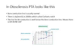 Otosclerosis 4th year [upl. by Ecirtaed]