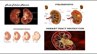 Pathology Urogenital  Tubular Disease amp Pyelonephritis amp Hydronephrosis amp Urinary Tract Obstruction [upl. by Ordnagela982]