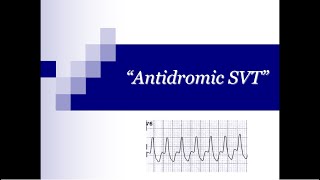 ECG Tip 21 What about quotAntidromicquot SVT [upl. by Regdor]