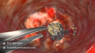 Medical Animation of CO2 Laser Surgery [upl. by Lawtun343]