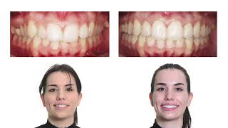 Caso real con ortodoncia Invisalign  Antesdespués [upl. by Ire]