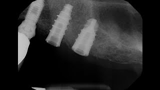 Implant Rescue of an Unknown Brand [upl. by Macdonell]