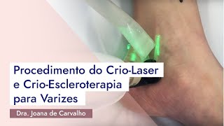 Procedimento do CrioLaser e CrioEscleroterapia para Varizes [upl. by Hopper]