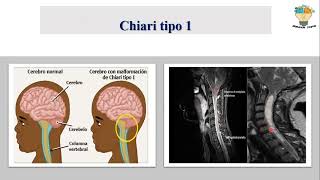 MALFORMACIONES CONGÉNITAS DEL ENCEFALO Hidrocefalia Chiari Craneosinostosis Dandy Walker [upl. by Olegnaid]