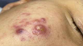 Satisfying With Loan Nguyen Spa Video 064 acnetreatment [upl. by Rania]