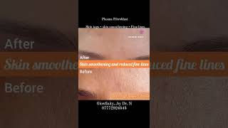 Plasma Fibroblast  Revolutionary Skin treatment  carbon crusts  non surgical skin treatment [upl. by Tuck]