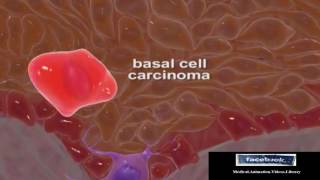 SCCC  Types of Skin Cancer 3D Medical Animation Video [upl. by Annaik]