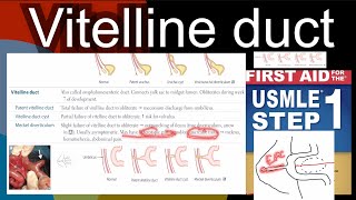 Vitelline duct  Patent vitelline duct Vitelline duct cyst Mackel diverticulum in HindiUrdu [upl. by Anitsrhc]