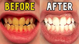 How I Whitened My Teeth in 14 Days [upl. by Garretson]