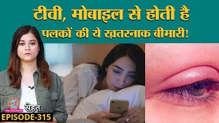 एक बार हो जाए तो ठीक नहीं होती पलकों की ये बीमारी  Blepharitis Sehat ep 315 [upl. by Eisoj]