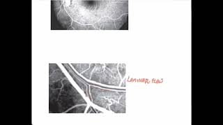 Normal Fluorescein AngiogramOphthalmology [upl. by Callean101]