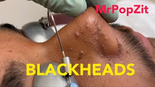 Tons of blackheads 17 minutes of extractionsBlackheads whiteheadsmilia Face and ears MrPopZit [upl. by Acsehcnarf]