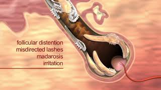 Learn how Demodex mites cause blepharitis [upl. by Adlai]