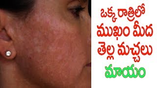 How To Get Rid Of White Spots Vitiligo On The Face [upl. by Leiahtan]