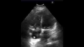 Pacemaker Associated Endocarditis [upl. by Irrot]